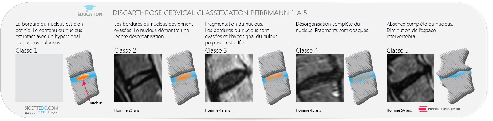 La classification Pfirrmann pour hernie discale cervicale.