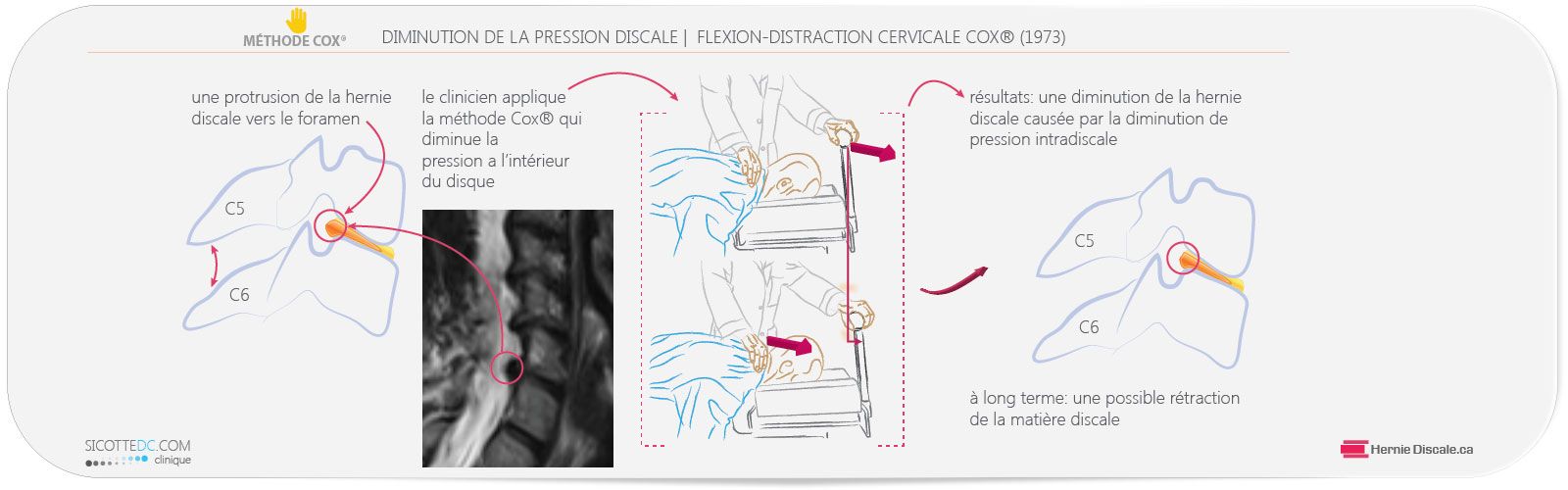 La diminution de la pression intradiscale de la hernie discale cervicale C5-C6 avec l'application de la méthode Cox®