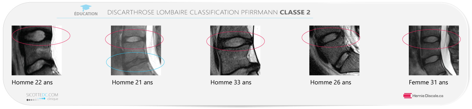 Example discarthrose lombaire classification Pfirrmann classe 2