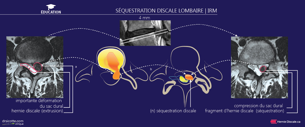 Séquestration discale avec explication du traitement.