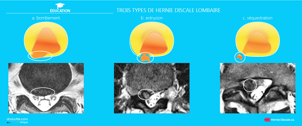 Le traitement de la hernie discale méthode Cox
