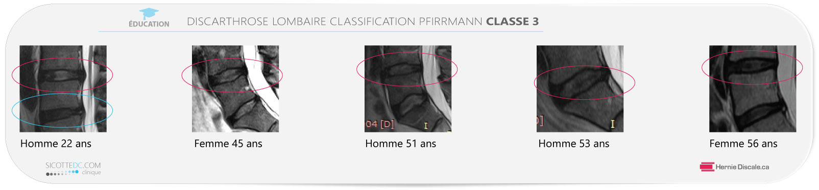 Example discarthrose lombaire classification Pfirrmann classe 3
