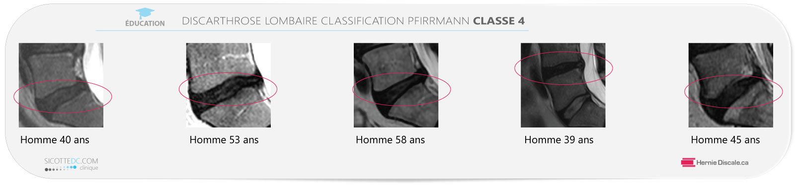 Example discarthrose lombaire classification Pfirrmann classe 4