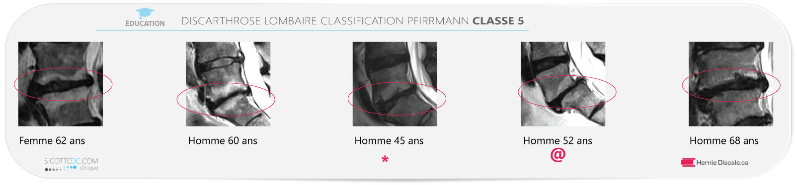Example discarthrose lombaire classification Pfirrmann classe 5