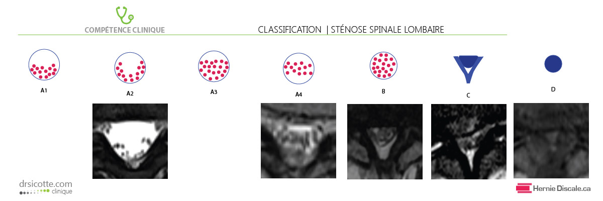 Classification de la sténose spinale basé sur la morphologie du sac dural.